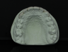 (4.) Facial, incisal, and intaglio views of the composite veneers that were designed and milled for teeth Nos. 6 through 11.