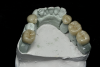 (8.) View of the maxillary and mandibular posterior full-coverage composite crowns, which were designed and milled with an increased vertical dimension position. This position was determined after intraoral testing was conducted with a leaf gauge instrument.