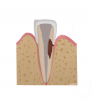 (7.) In cases in which an infrabony defect is inaccessible or surgical access would result in excessive removal of sound tooth structure, internal repair is the treatment of choice.