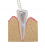 (9.) The defect should be irrigated with saline as opposed to sodium hypochlorite because the portal allows for direct communication with the periodontal ligament space and a hypochlorite accident could occur.