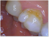 Fig 5a. Kerr SimpliShade Bulk Fill one-shade composite is used to blend and match the natural characteristics of the tooth.