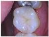 Fig 6d. A procedure using a bulk fill packable as an interproximal Class 2, without using a bulk fill flow and not done with the
snowplow technique. A light curable resin-modified calcium silicate liner (Bisco TheraCal LC) was used to perform an indirect pulp cap. A
packable bulk fill composite was applied as a single increment layer. The material (Kerr SimpliShade Bulk Fill Packable) was used to provide
good adaptation to the tooth without gaps or polymerization stress lines and demonstrated great polishability and blendability.