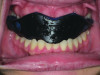 (3.) Intraoral facial and occlusal views, respectively, of the completed boil-and-bite sports mouth guard.