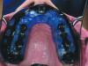(4.) Intraoral facial and occlusal views, respectively, of the completed boil-and-bite sports mouth guard.