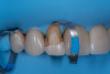 (2.) An intraoral view of the maxillary anterior region, where most teeth are restored with ceramic facings. The upper lateral incisor is fractured, with only the ceramic in the incisal third remaining in place. The cervical and middle thirds of the facing are lost, exposing the underlying tooth structure.
