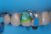 (7.) Protection of adjacent teeth and the dentin tissue during surface treatment of the fractured ceramic margin.