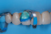 (8.) Protection of adjacent teeth and the dentin tissue during surface treatment of the fractured ceramic margin.