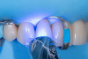 (11.) Simultaneous light polymerization of the adhesive and composite after careful removal of all excess material.