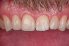 (14.) Intraoral view showing the fractured ceramic fragment positioned in place. The piece fits well, although minor gaps are present between the margins due to slight material loss, which can be restored using luting composite.