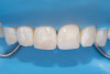 (27.) Final intraoral view after complete polymerization under glycerin gel, showing a seamless repair with invisible margins, making the fracture line undetectable.