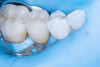 (31.) Crown properly seated in position, followed by light polymerization of the cement and careful removal of all excess.