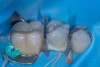 (38.) Fractured cusp after adhesive bonding and polishing of the finish line, resulting in a smooth and seamless transition and 25-month follow up radiograph where the adhesively bonded fracture line is visible.
