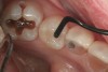 3. A composite placing instrument (Flexi-Thin Mini 4, Hu-Friedy, www.hu-friedy.com) is used to shape occlusal morphology on this bulk-filled composite restoration (Tetric EvoCeram Bulk Fill, Ivoclar Vivadent) prior to light curing.