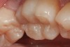 4. A post-polish view of the distal occlusal bulk-filled composite (Beautifil-Bulk Restorative, Shofu) on tooth No. 19. Note the luster as a result of nanofilled composite technology and the chameleon effect that blends the restoration with the tooth surface.