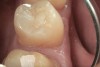 8. A proximal view of the distal occlusal composite placed on tooth No. 29 with SonicFill. The corners of the proximal box where the vertical walls meet the gingival wall are completely filled. This is an area where failure can occur if not filled properly.