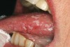 Figure 3  Oral candidiasis (pseudomembranous) is seen as elevated white plaques on the dorsal and lateral surfaces of the tongue.