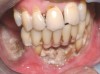 Figure 1  Exposed bone in the mandibular jaw that is characteristic of BRONJ. Photo courtesy of Robert Marx, DDS.