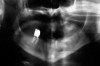 Figure 4  Radiograph of oral bisphosphonate user.