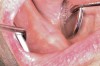Figure 5  After 2 months of healing, the lower right quadrant showed no signs of BRONJ and the anterior teeth were scheduled for extraction.