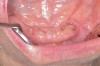 Figure 6  After 2 months of healing, the lower right quadrant showed no signs of BRONJ and the anterior teeth were scheduled for extraction.