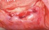 Figure 7  Anterior extraction sites after atraumatic removal.