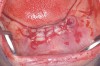 Figure 8  Anterior extraction sites after atraumatic removal.