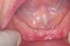 Figure 9  Anterior extraction sites after atraumatic removal.