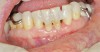 Figure 12  Facial view of composite splint.