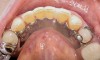 Figure 13  Occlusal view of composite splint.