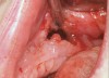 Figure 15  Removal of the necrotic bone material.