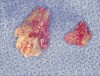 Figure 16  Necrotic bone.