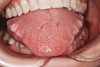 Figure 4   Indentations on tongue caused by forceful pressing of tongue on lingual surfaces. By pushing the tongue anteriorly, the airway is opened.