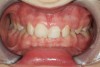 Figure 12  Childhood presentation of the bruxism triad. Patient had erosive and attritional wear on deciduous teeth, constricted dental arches, and deep class II bite. Physician examination revealed significant GERD paired with enlarged adenoids and tonsils.
