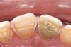 Figure 22  Incisal view demonstrates the damage from sleep bruxism and the erosive wear associated with GERD and tongue position.