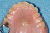 Figure 24  Many dentures worn at night demonstrate the same lateral wear facets indicative of the bruxism triad patient. A complete history of bruxism, sleep, and GERD should be obtained.