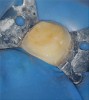 Figure 5  The space between the rubber dam clamp and the tooth should be sealed with a caulking material of choice. Once final isolation is obtained, the integrity of the fluid-tight seal should be checked by flooding and submerging the isolated tooth with sodium-hypochlorite solution. If the patient cannot taste the bleach material, a proper seal has been achieved.