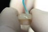 Figure  10  Because bis-acryls are somewhat rough and tend to wear if left for any protracted amount of time, a glaze is placed over the temporary material.