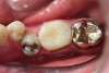 Figure  11   Because the temporary is now smooth and non-porous, the temporary cement is much easier to remove, as it does not stick to the provisional.