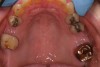 Figure  17  A diagnostic and/or treatment wax-up is fabricated.