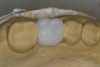 Figure 18  A diagnostic and/or treatment wax-up is fabricated.