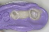 Figure 21  The mock-up is impressed,removed, loaded with bis-acryl, and re-inserted over the prepared teeth to create a provisional that needs little contouring and finishing.