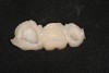 Figure 22 The mock-up is impressed,removed, loaded with bis-acryl, and re-inserted over the prepared teeth to create a provisional that needs little contouring and finishing.