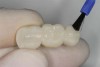 Figure 23  After application of the glaze, the temporary is inserted with temporary cement, the excess removed, and the occlusion is verified.