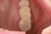 Figure 24  After application of the glaze, the temporary is inserted with temporary cement, the excess removed, and the occlusion is verified.