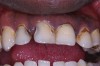 Figure 1  This patient had a history of drinking five to six bottles of an acidic carbonated beverage a day, leading to combined dental erosion–caries.