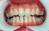 Figure 8  Prior to at-home whitening (left). Following approximately 10 days of at-home tray whitening (right).