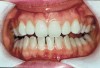Figure 9  Prior to at-home whitening (left). Following approximately 10 days of at-home tray whitening (right).